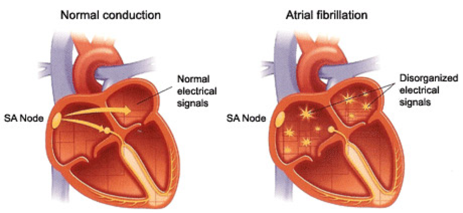 atrial-fibrillation-af-hillcrest-spinal-centre